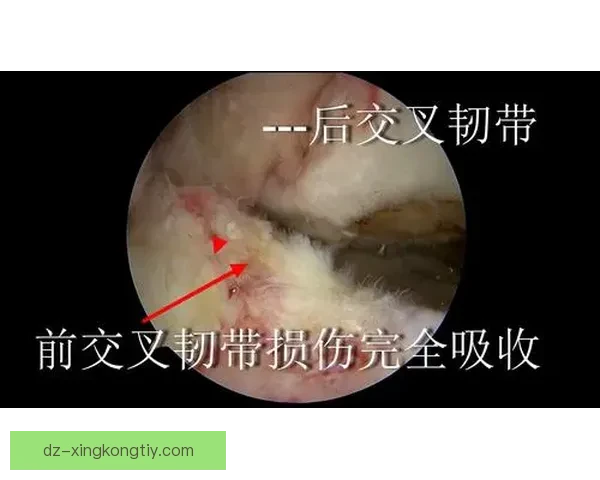 巴特勒膝伤退疑前交叉韧带损伤 巴特勒膝伤退疑前交叉韧带损伤