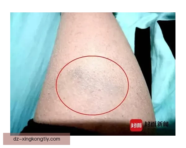 官方通报张宁腿伤休战六至八周